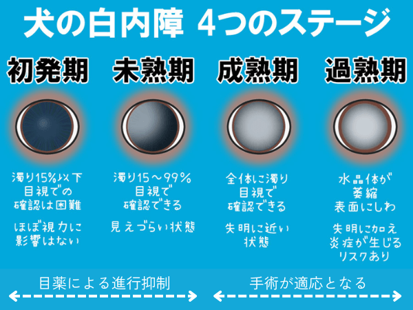 白内障のステージ